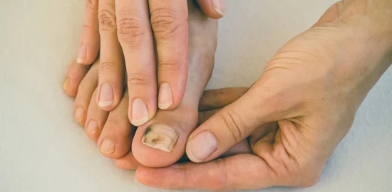 Промени в цвета на ноктите и неговото значения: От меланом до гъбични инфекции